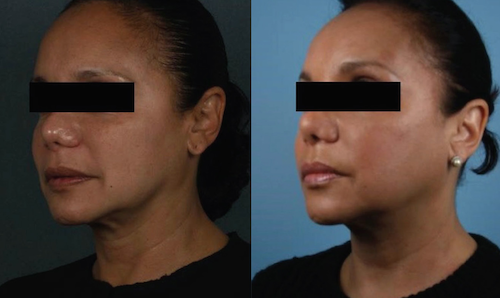 thread lift before after mississauga oakville toronto